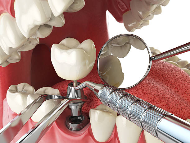 Best Emergency Root Canal Treatment in North Myrtle Beach, SC